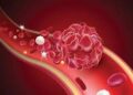 Blood Clots: A Silent Threat Leading to Heart Attack and Stroke.
